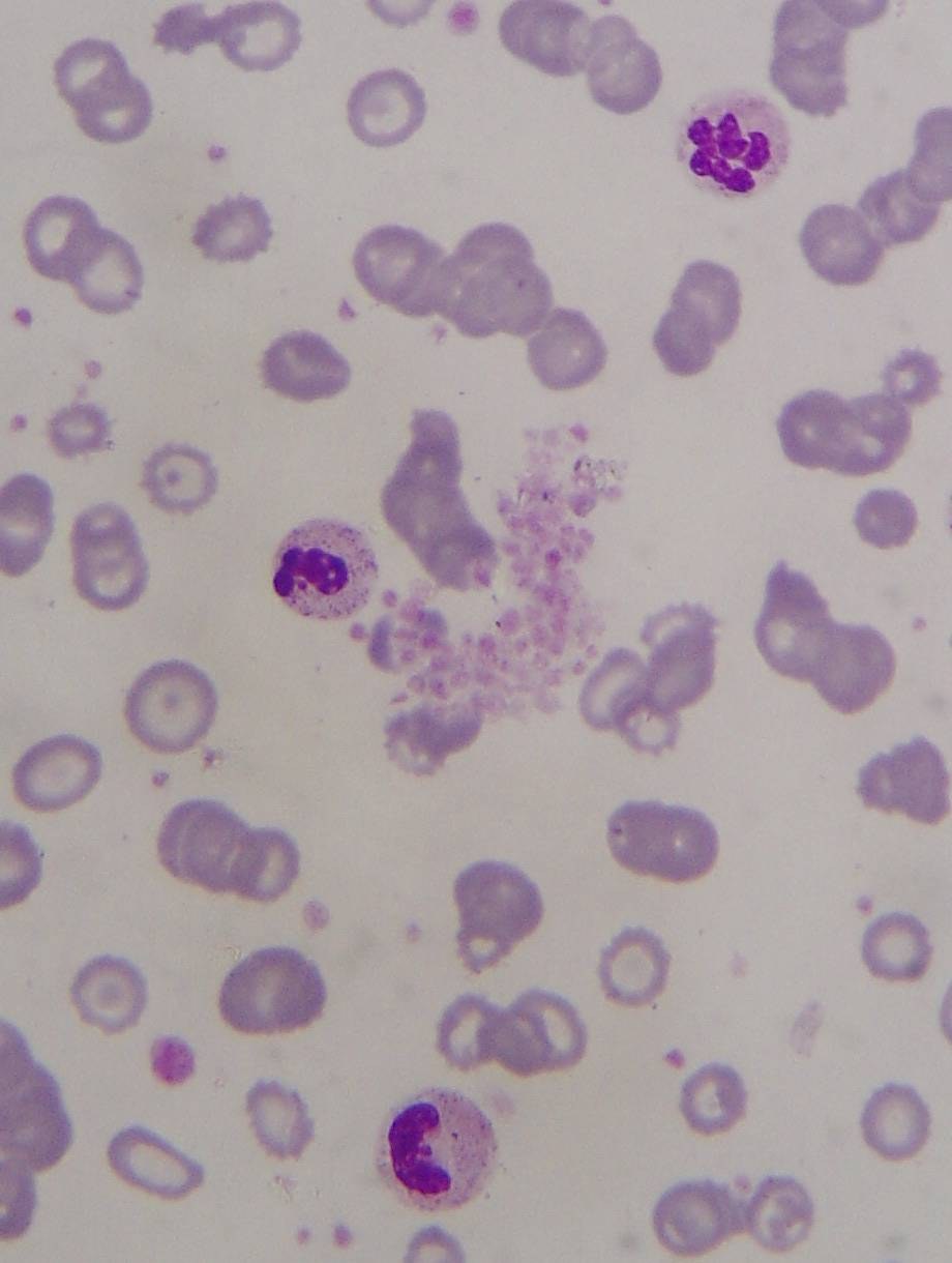 Platelet clumps on peripheral blood smear